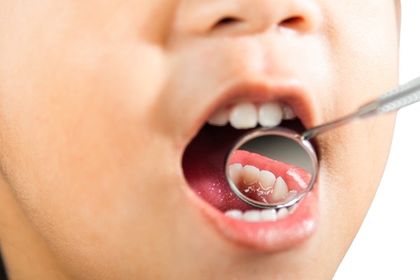 How Dental Sealants Prevent Cavities In Kids